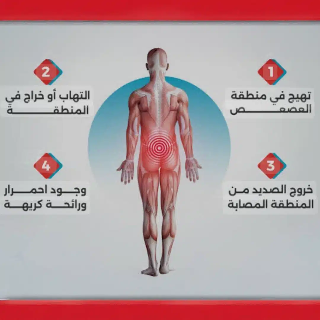 الناسور العصعصي مشكلة بسيطة لكن ألمها يؤثر على حياتك… اكتشف أعراضها وعلاجها